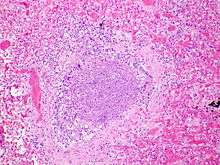 Acute inflammatory exudate occluding the lumen of the bronchiole and acute inflammation of part of the wall of the bronchiole