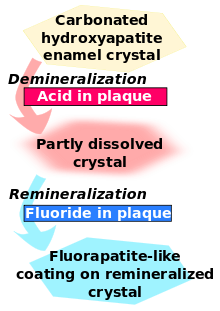 Carbonated hydroxyapatite enamel crystal is demineralized by acid in plaque and becomes partly dissolved crystal. This in turn is remineralized by fluoride in plaque to become fluorapatite-like coating on remineralized crystal