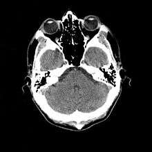 An slice through the head, showing the cerebellum, a small portion of each temporal lobe, the ears, the orbits, and the sinuses. Bone appears white on the black background; brain, eyeballs and ears are grey.