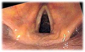 View of the glottis as seen during laryngoscopy