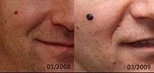 Evolution of a 4 mm nodular melanoma.