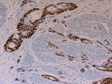 Urachal cancer - CDX2 immunohistochemistry